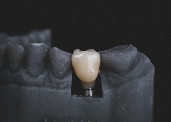 dental-implants/implant-restoration/