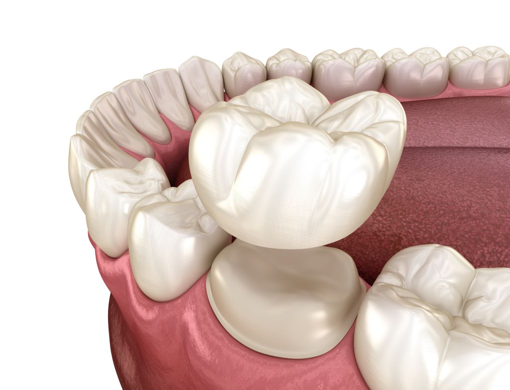 dental crown and bridges