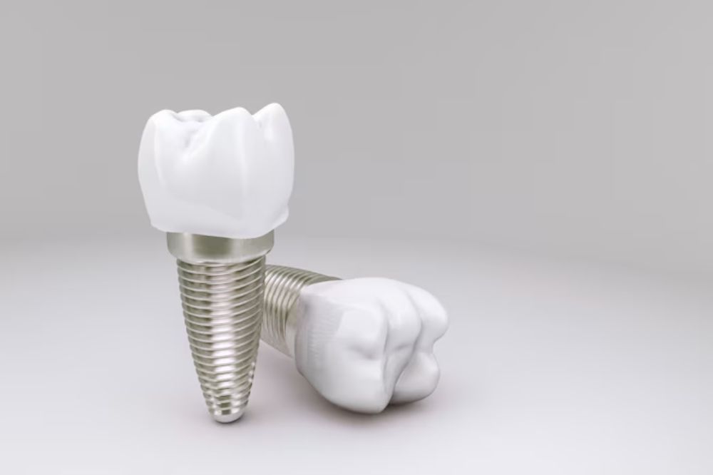 single-tooth-implants-what-to-expect-before-during-and-after