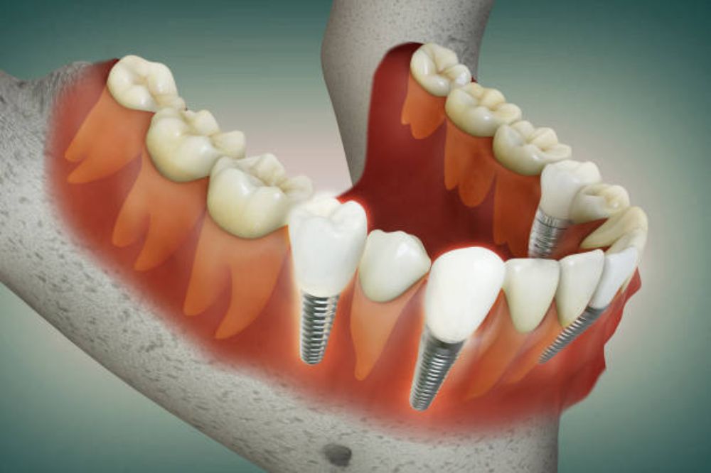 what-are-the-risks-of-getting-multiple-tooth-implants