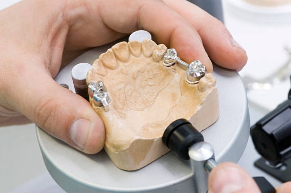 dental crowns or bridges