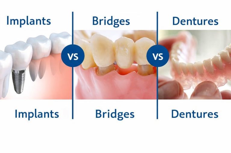 Dental Implants vs Dentures vs Bridges | Which to Choose