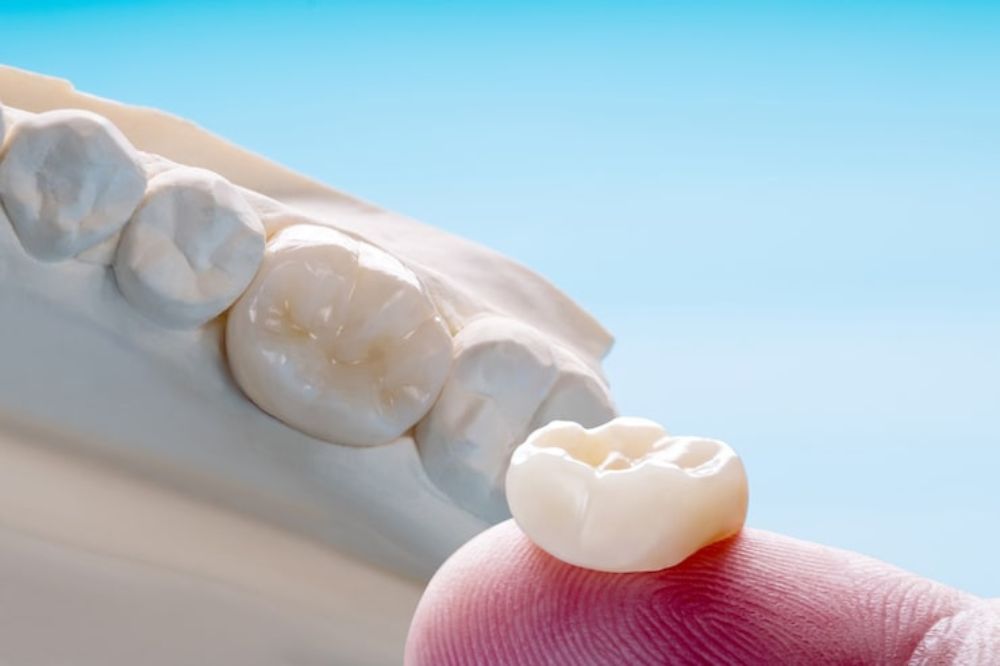 Dental Crowns and Bridges